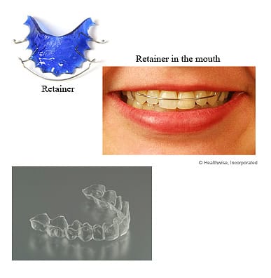 Retention is an essential part of your orthodontic treatment
