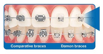 Revolutionary braces and wire