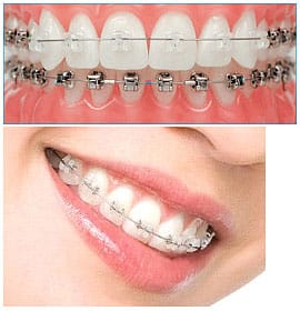 Dental braces also include the ceramic braces and these are more popular among teenagers