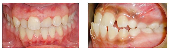 Periodontal problems including gum disease and bone loss.