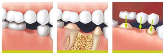 This results in a loss of natural tooth surface