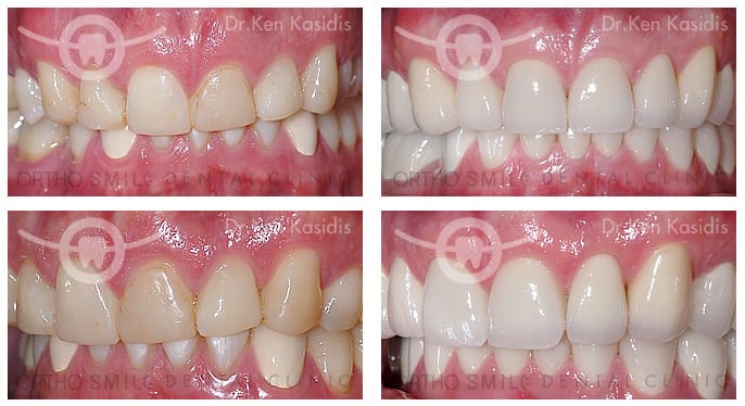 Full mouth rehabilitation with ceramic crowns 3