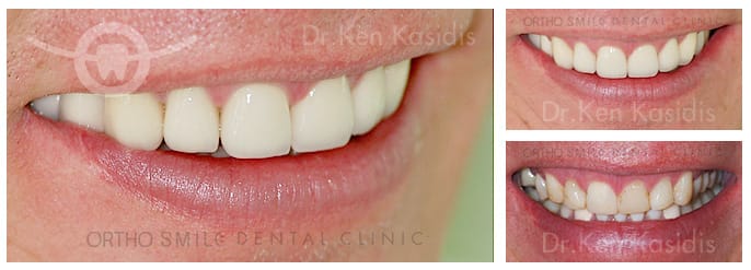 Full mouth rehabilitation with ceramic crowns 4