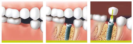 The healthy neighbouring teeth