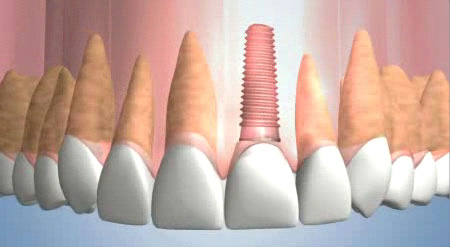 Dental implants are made from titanium that is coated with a special coating that encourages the bone to grow around it.