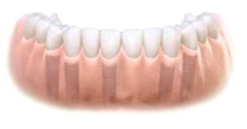 The dental implant bridge