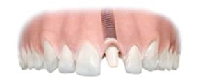 The abutment is attached to the dental implant. A crown is then placed on the abutment, fitting perfectly at the edge of the gum.