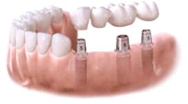 Abutments are attached to the dental implants.