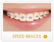 speed braces