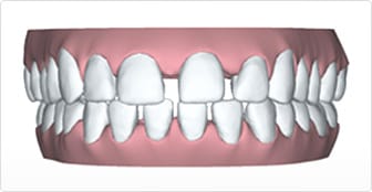 Widely spaced teeth