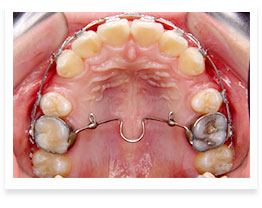 img-braces-10.jpg