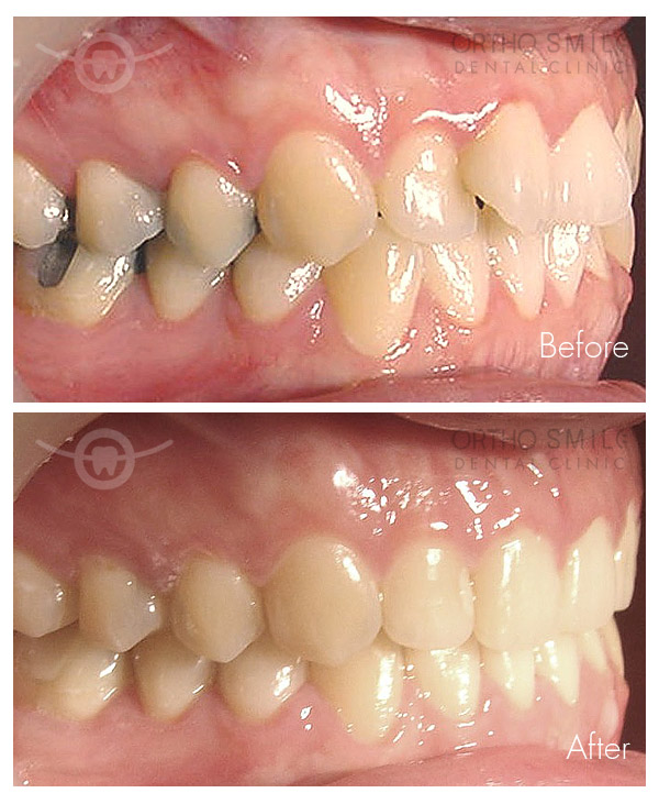 invisalign_braces_dental_pattaya_ortho_s