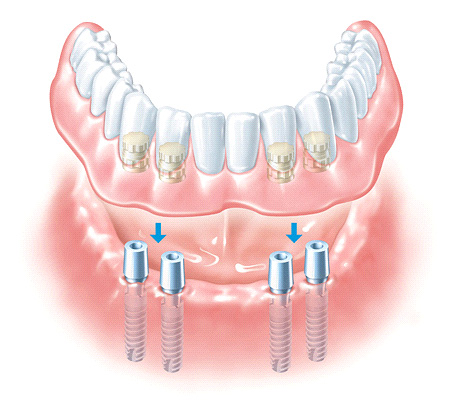 orthosmile_sr_dental_imgf.jpg