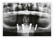 Dental Implant Pattaya Implantologist Dentist