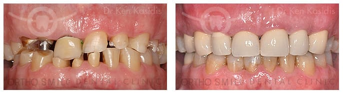 Full mouth rehabilitation with ceramic crowns 1