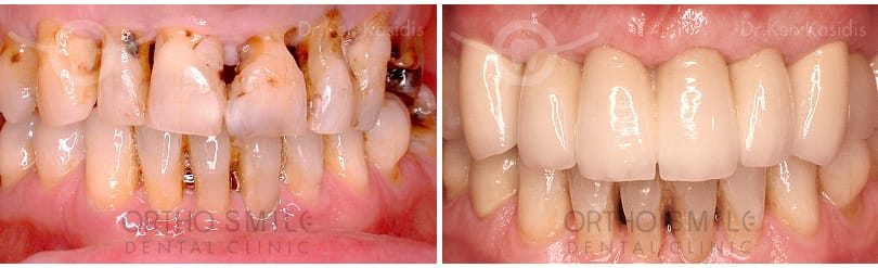 Replacing unstable or infected teeth