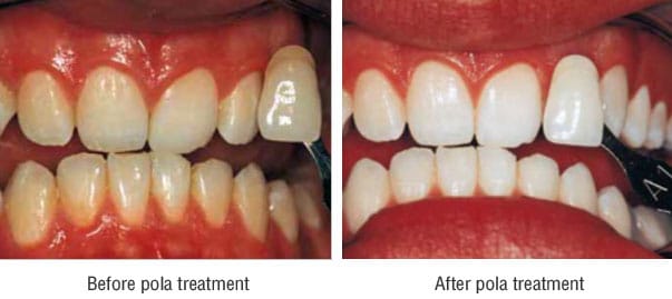 polaroffice teeth whitening